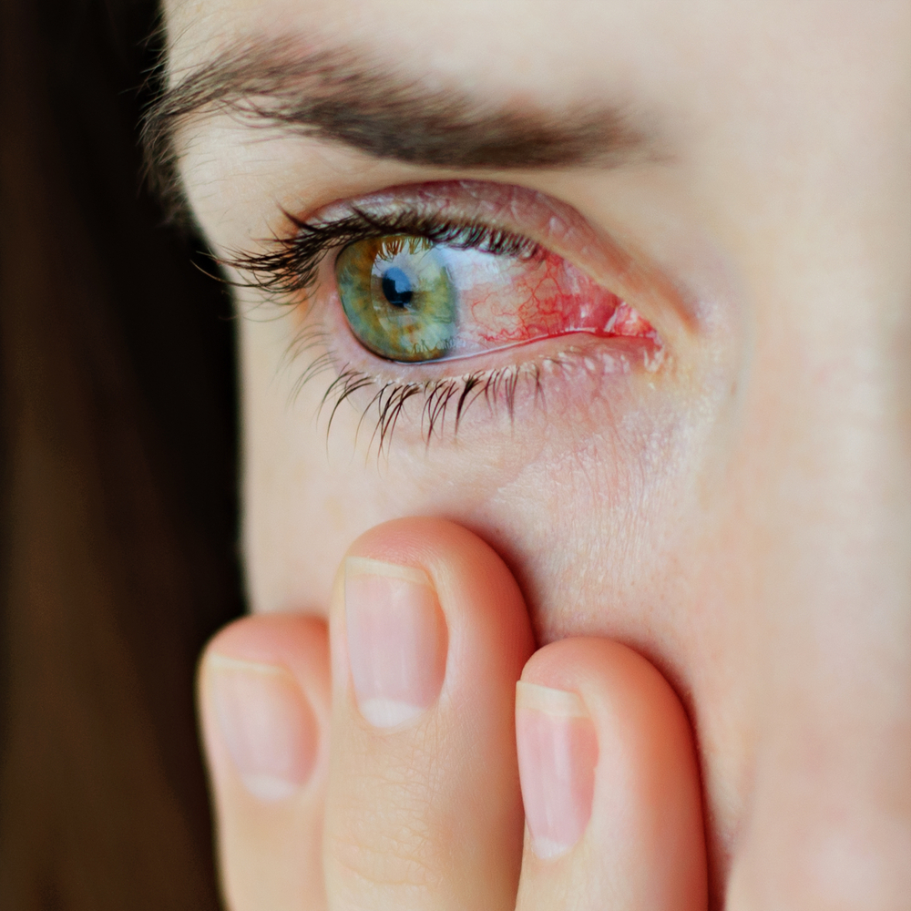 تختلف أعراض جلطة العين على حسب موقع الوعاء الدموي المصاب