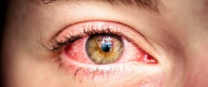  لوحظ مؤخرًا حدوث جلطة العين عند بعض المرضى المصابين بفيروس كوفيد 19