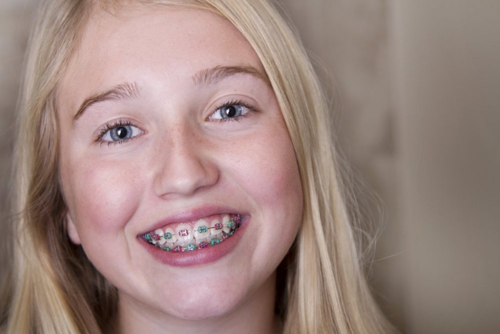  تسوس الأسنان وترتيب الأسنان من المشاكل الشائعة عند المراهقين