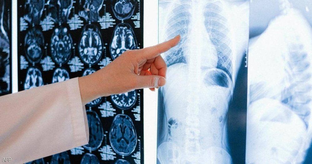 منح الأسبقية لمرضى سرطان الرئة في الإمارات في الحصول على العلاج