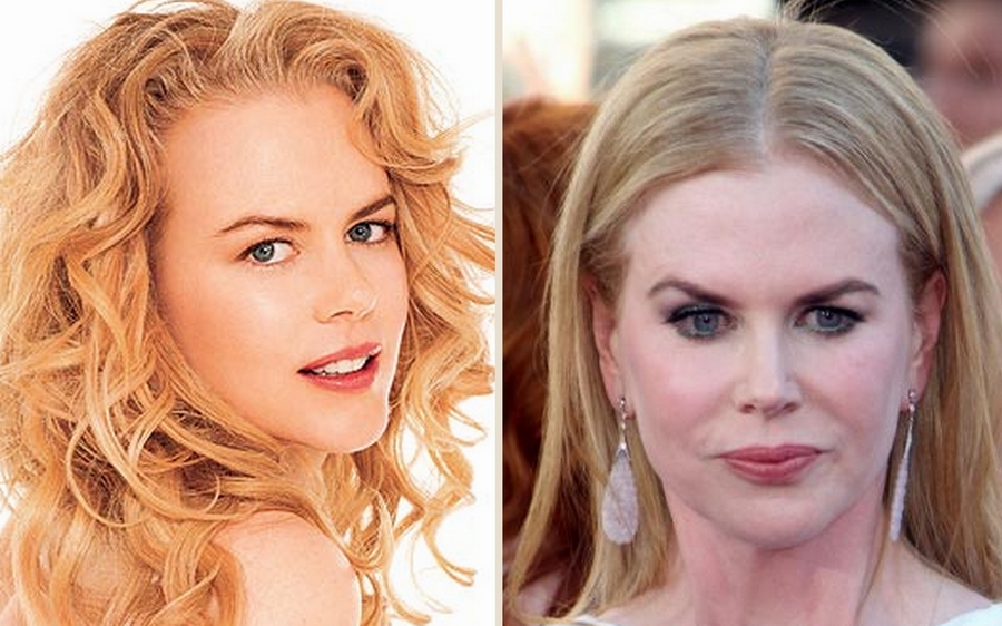 Nicole Kidman’s Use of Botox