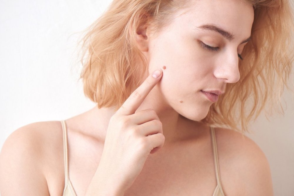 طرق إزالة شامة الوجه بالعلاجات الطبيعية الفعالة