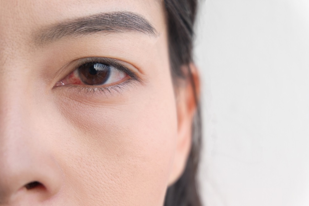 كيف يمكن تشخيص جلطة العين وما هي مضاعفاتها