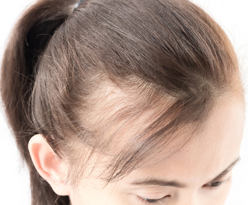 العوامل الوراثية وشد الشعر وسوء التغذية من اهم اسباب فراغات الشعر الامامية