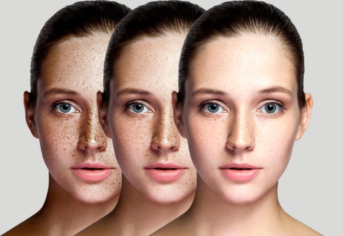 نصائح جمالية لعلاج النمش في الوجه - مجلة هي