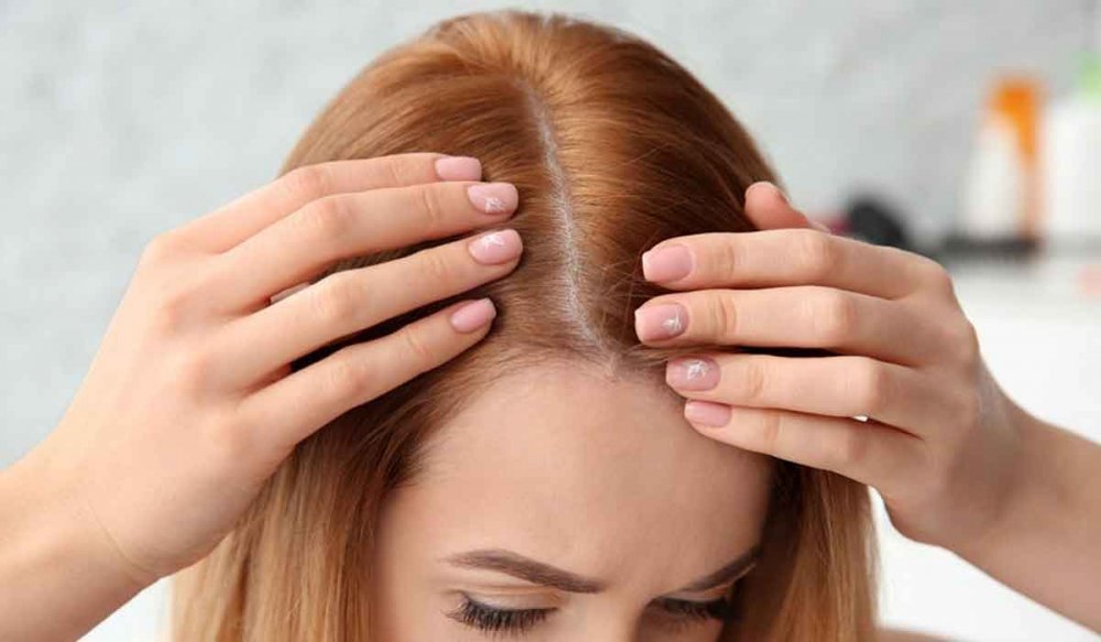 زراعة الشعر هو إجراء يتم فيه نقل الشعر إلى منطقة أصلع من الرأس لتكثيفها