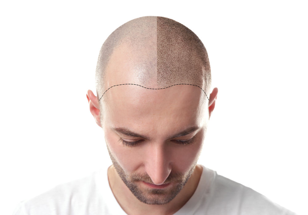 أسباب تساقط الشعر عن الرجال قد تكون وراثية أو نتيجة أمراض مزمنة 