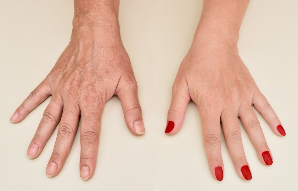 تجميل اليدين بالليزر للتخلص من علامات الشيخوخة