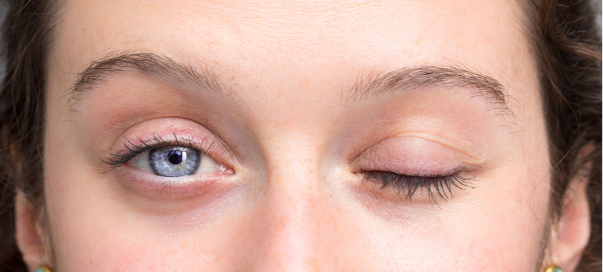 ما هي متلازمة العين الجافة