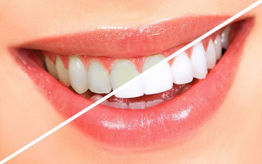 قد تصبح أسنانك حساسة بعد عملية تبييض الأسنان بالليزر