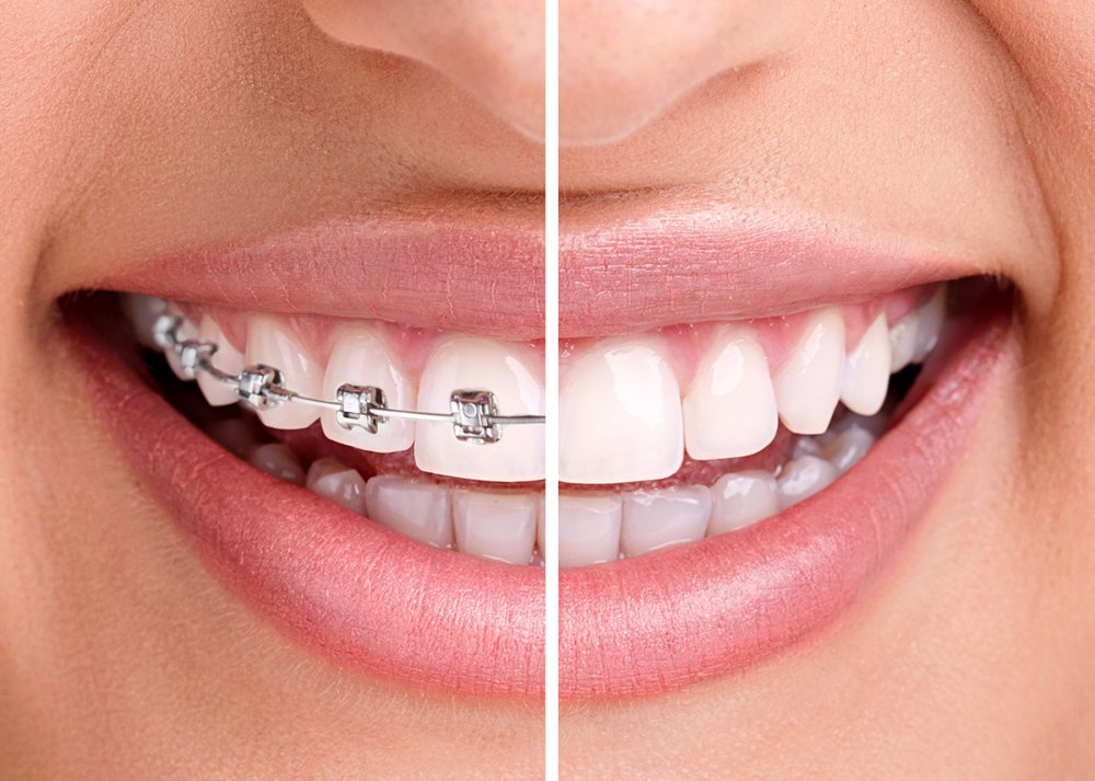 ما هي فوائد و اضرار تقويم الاسنان مجلة هي