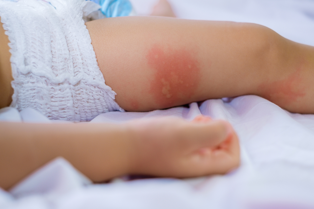  الحساسية والطفح الجلدي والحكة من اضرار الفول السوداني للاطفال الرضع