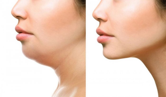 شفط دهون الوجه بالليزر هو بديل لشد بشرة الوجه بطريقة آمنة وفعالة