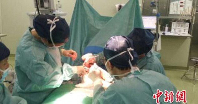 إزالة الرجل الزائدة في أول تدخل جراحي للطفل