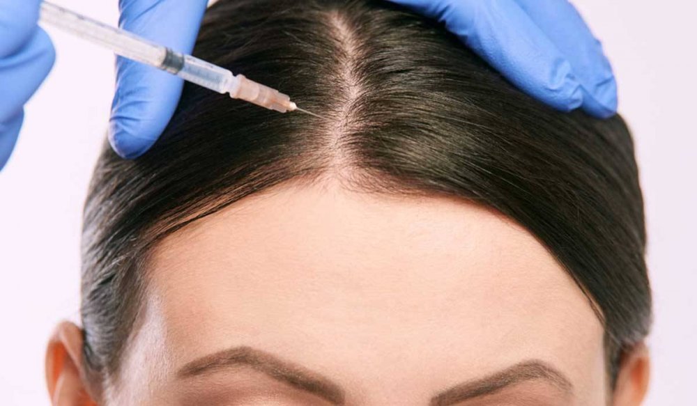 حقن الكولاجين للشعر لعلاج تساقط الشعر