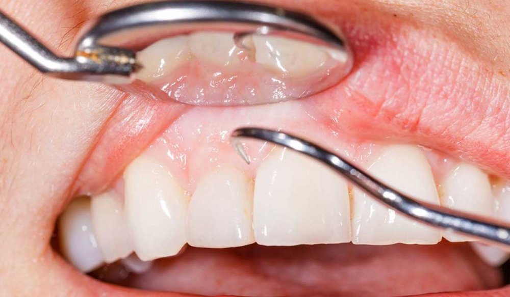 طريقة زراعة الاسنان ومراحلها بالتفصيل - مجلة هي