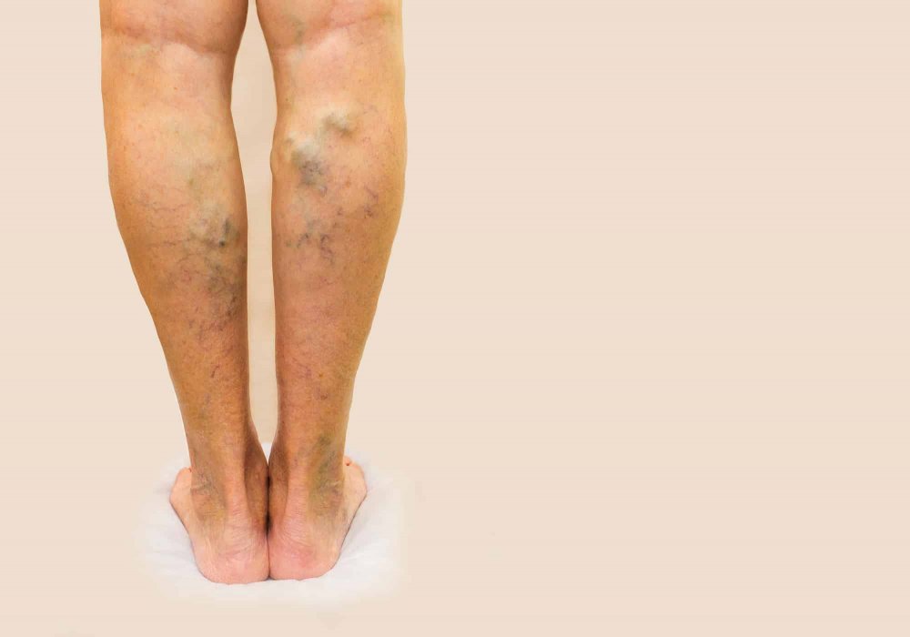 وصفات طبيعية لعلاج دوالي الساقين للحصول على أقدام ناعمة