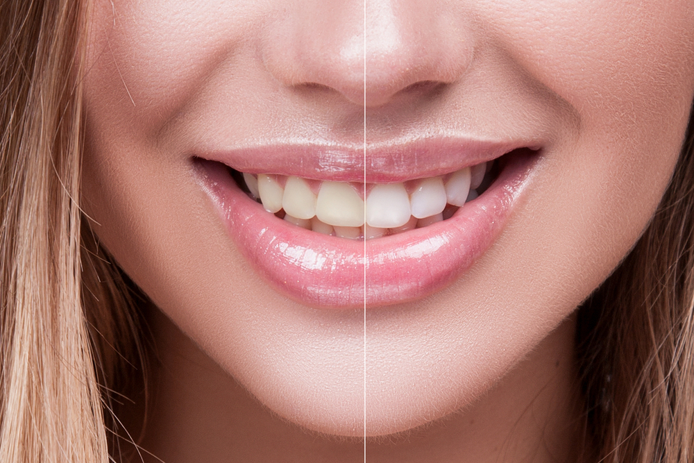 أفضل طرق طبيعية لتبييض الأسنان والتخلص من الإصفرار