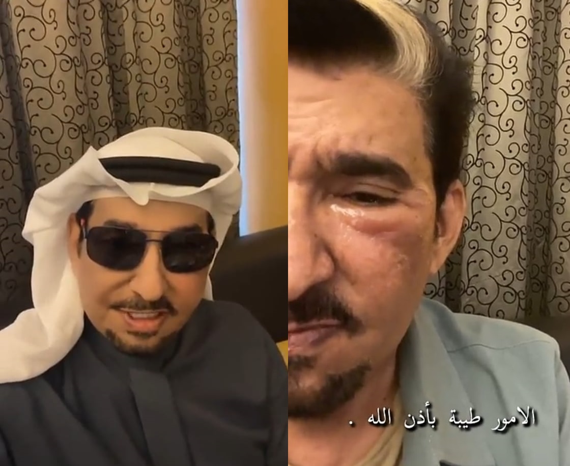 إصابة عبدالله السدحان في الوجه